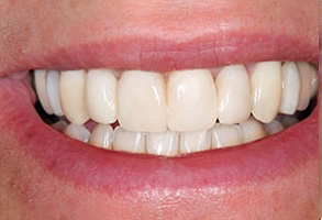 Before and After Invisalign in Rocklin