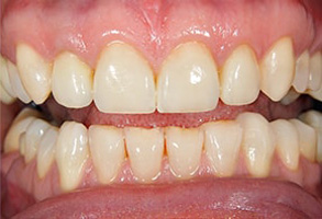 Rocklin Before and After Dental Implants