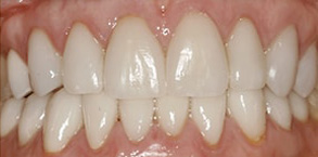 Before and After Dental Bleaching Rocklin