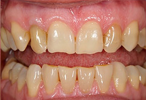 Before and After Dental Implants Rocklin