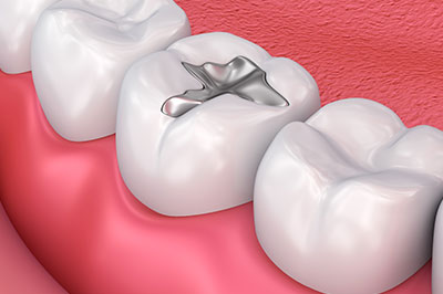 Rocklin Amalgam Fillings