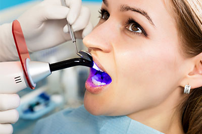 dental bonding in Rocklin