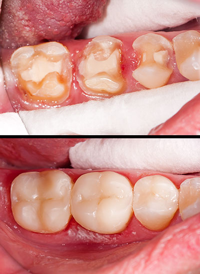 Rocklin Composite Fillings