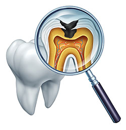 Rocklin Tooth Decay