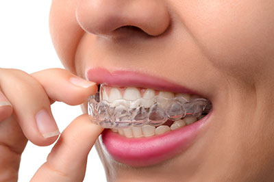 Rocklin invisalign