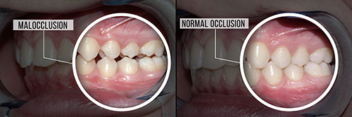 Rocklin Malocclusion