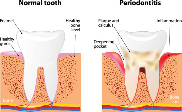 Periodontal (Gum) Disease in Rocklin