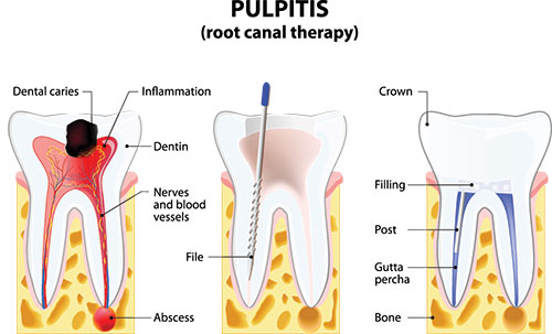 Root Canal Therapy in Rocklin