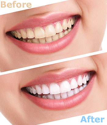 Rocklin teeth whitening