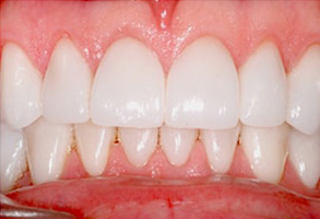 Before and After Dental Braces Rocklin