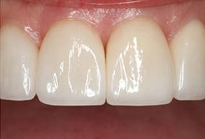 Before and After Teeth Whitening Rocklin