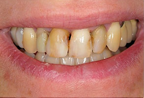 Rocklin Before and After Invisalign