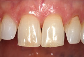 Rocklin Before and After Teeth Whitening