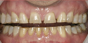 Rocklin Before and After Dental Bleaching